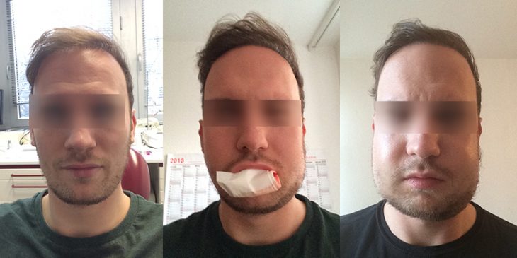 Meine Weisheitszahn OP Erfahrungen | Weisheitszahn-OP.net